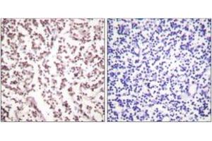 Immunohistochemistry analysis of paraffin-embedded human lymph node tissue, using Bloom Syndrome (Ab-99) Antibody. (Bloom Syndrome (AA 65-114) Antikörper)