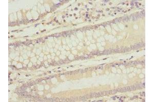 Immunohistochemistry of paraffin-embedded human colon cancer using ABIN7171839 at dilution of 1:100 (ASPSCR1 Antikörper  (AA 284-553))