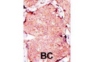 Formalin-fixed and paraffin-embedded human breast cancer tissue reacted with AK3L1 polyclonal antibody  , which was peroxidase-conjugated to the secondary antibody, followed by AEC staining. (AK4 Antikörper  (C-Term))