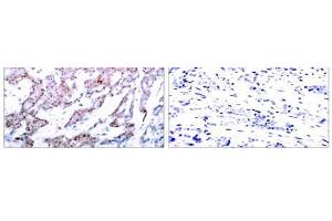 Immunohistochemical analysis of paraffin-embedded human breast carcinoma tissue using NF-κB p65 (phospho-Ser536) antibody (E011014). (NF-kB p65 Antikörper  (pSer536))