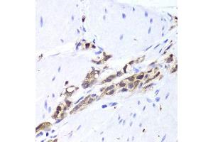 Immunohistochemistry of paraffin-embedded human gastric cancer using TPPP3 antibody. (TPPP3 Antikörper  (AA 1-176))