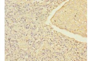 Immunohistochemistry of paraffin-embedded human lung cancer using ABIN7168214 at dilution of 1:100 (MRRF Antikörper  (AA 56-262))