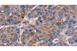 Immunohistochemistry of paraffin-embedded Human liver cancer using NPM3 Polyclonal Antibody at dilution of 1:60 (NPM3 Antikörper)