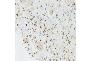Immunohistochemistry of paraffin-embedded human gastric cancer using EFTUD2 Antibody (ABIN5974236) at dilution of 1/100 (40x lens). (EFTUD2 Antikörper)