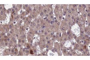 ABIN6277552 at 1/100 staining Human liver cancer tissue by IHC-P. (GFRA1 Antikörper  (Internal Region))