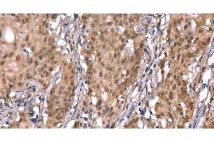 Immunohistochemistry of paraffin-embedded Human gasrtic cancer tissue using KCNJ6 Polyclonal Antibody at dilution 1:40 (KCNJ6 Antikörper)