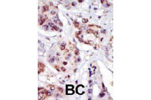Formalin-fixed and paraffin-embedded human cancer tissue reacted with PIP4K2C polyclonal antibody  , which was peroxidase-conjugated to the secondary antibody, followed by AEC staining. (PIP4K2C Antikörper  (C-Term))