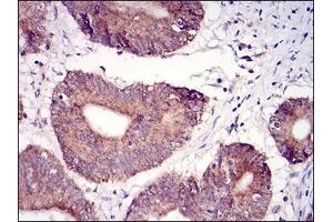 Immunohistochemical analysis of paraffin-embedded colon cancer tissues using TUBE1 mouse mAb with DAB staining. (TUBE1 Antikörper  (AA 314-472))