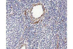 Immunohistochemistry analysis of paraffin-embedded human Lymphoma using LDLR Polyclonal Antibody at dilution of 1:300. (LDLR Antikörper)