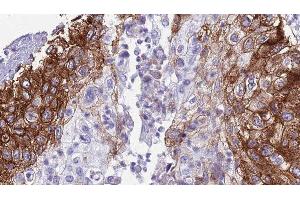 ABIN6276730 at 1/100 staining Human urothelial cancer tissue by IHC-P.