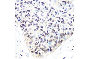 Immunohistochemistry of paraffin-embedded human esophageal cancer using Exportin 5 (XPO5) (XPO5) Rabbit mAb (ABIN1682763, ABIN3018126, ABIN3018127 and ABIN7101577) at dilution of 1:100 (40x lens). (XPO5 Antikörper)
