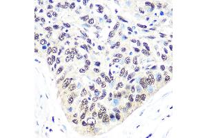 Immunohistochemistry of paraffin-embedded human esophageal cancer using Exportin 5 (XPO5) (XPO5) Rabbit mAb (ABIN1682763, ABIN3018126, ABIN3018127 and ABIN7101577) at dilution of 1:100 (40x lens).