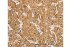 Immunohistochemistry of Human thyroid cancer using NGF Polyclonal Antibody at dilution of 1:50 (Nerve Growth Factor Antikörper)