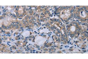 Immunohistochemistry of paraffin-embedded Human thyroid cancer using HOMER1 Polyclonal Antibody at dilution of 1:50 (HOMER1 Antikörper)