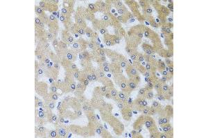 Immunohistochemistry of paraffin-embedded human liver injury using UVRAG antibody. (UVRAG Antikörper  (AA 501-699))