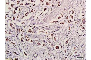 Formalin-fixed and paraffin embedded human breast cancer labeled with Anti-Ubiquitin/UBC/UB Polyclonal Antibody, Unconjugated (ABIN731183) followed by conjugation to the secondary antibody and DAB staining (Ubiquitin Antikörper  (AA 1-76))