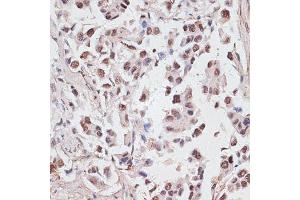 Immunohistochemistry of paraffin-embedded human lung cancer using DKC1 antibody (ABIN6127762, ABIN6139635, ABIN6139636 and ABIN6216722) at dilution of 1:100 (40x lens). (DKC1 Antikörper  (AA 1-180))