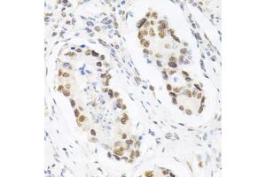 Immunohistochemistry of paraffin-embedded human gastric cancer using KPNA4 Antibody (ABIN5971058) at dilution of 1/200 (40x lens). (KPNA4 Antikörper)