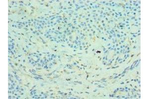 Immunohistochemistry of paraffin-embedded human breast cancer using ABIN7159067 at dilution of 1:100 (MMP14 Antikörper  (AA 260-540))