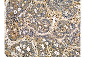 ABIN7095555 and ABIN7099612 at 1/100 staining human breast cancer by IHC-P. (KCNK16 Antikörper)