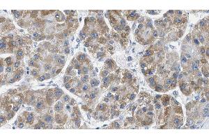ABIN6269344 at 1/100 staining Human liver cancer tissue by IHC-P. (PAK1 Antikörper  (Internal Region))
