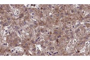 ABIN6273969 at 1/100 staining Human liver cancer tissue by IHC-P. (OR1J1 Antikörper)