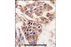 Formalin-fixed and paraffin-embedded human breast carcinoma tissue reacted with C8orf32 antibody , which was peroxidase-conjugated to the secondary antibody, followed by DAB staining.