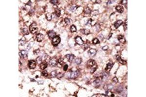 IHC analysis of FFPE human hepatocarcinoma tissue stained with the SIRT7 antibody (SIRT7 Antikörper  (AA 331-360))