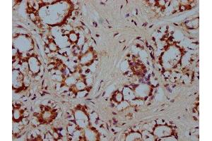 IHC image of ABIN7155703 diluted at 1:300 and staining in paraffin-embedded human breast cancer performed on a Leica BondTM system. (HMX2 Antikörper  (AA 1-150))