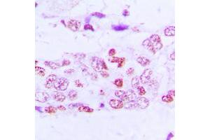 Immunohistochemical analysis of GSK3 alpha/beta (pY279/216) staining in human lung cancer formalin fixed paraffin embedded tissue section. (GSK3 alpha/beta Antikörper  (pTyr216, pTyr279))