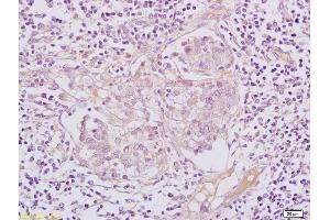 Formalin-fixed and paraffin embedded human lymphoma tissue labeled with Anti-AFAP/AFAP-110 Polyclonal Antibody, Unconjugated (ABIN1387171) at 1:200 followed by conjugation to the secondary antibody