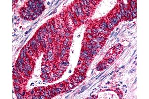 Anti-BOB / GPR15 antibody IHC of human Colon, Carcinoma. (GPR15 Antikörper  (Cytoplasmic Domain))