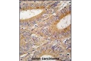 Formalin-fixed and paraffin-embedded human colon carcinoma tissue reacted with AIK antibody (N-term) (ABIN392389 and ABIN2842017) , which was peroxidase-conjugated to the secondary antibody, followed by DAB staining. (Aurora A Antikörper  (N-Term))