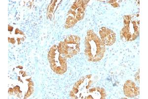 Formalin-fixed, paraffin-embedded human Rectum stained with Villin Monoclonal Antibody (VIL1/1314). (Villin 1 Antikörper  (AA 179-311))