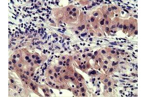 Immunohistochemical staining of paraffin-embedded Carcinoma of Human bladder tissue using anti-SH3GL1 mouse monoclonal antibody. (SH3GL1 Antikörper)