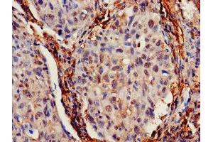 IHC image of ABIN7156683 diluted at 1:700 and staining in paraffin-embedded human lung cancer performed on a Leica BondTM system. (IFITM2 Antikörper  (AA 1-56))