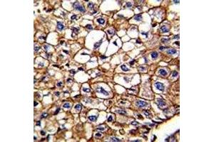 IHC analysis of FFPE human hepatocarcinoma tested with CD34 antibody