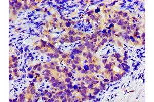 Immunohistochemistry of paraffin-embedded human pancreatic cancer using ABIN7146350 at dilution of 1:100 (SLC25A12 Antikörper  (AA 202-317))