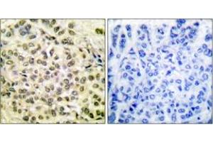 Immunohistochemistry analysis of paraffin-embedded human breast carcinoma, using C/EBP-beta (Phospho-Thr235/188) Antibody. (CEBPB Antikörper  (pThr235))