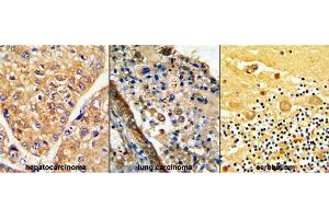 Formalin-fixed and paraffin-embedded (from Left to Right) human hepatocarcinoma, lung carcinoma and cerebellum reacted with GARP Antibody (Center), which was peroxidase-conjugated to the secondary antibody, followed by DAB staining.