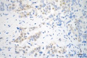 Immunohistochemistry was performed on paraffin-embedded human breast carcinoma using STAT5B antibody (ABIN7800348), 1:200). (Rekombinanter STAT5B Antikörper)