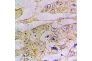 Immunohistochemical analysis of Ferritin L staining in human lung cancer formalin fixed paraffin embedded tissue section. (Ferritin L Antikörper)