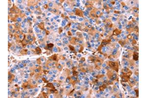 The image on the left is immunohistochemistry of paraffin-embedded Human liver cancer tissue using ABIN7190588(ERN2 Antibody) at dilution 1/40, on the right is treated with synthetic peptide. (ERN2 Antikörper)