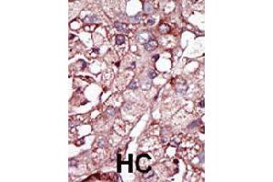 Formalin-fixed and paraffin-embedded human hepatocellular carcinoma tissue reacted with ACVRL1 polyclonal antibody  , which was peroxidase-conjugated to the secondary antibody, followed by DAB staining. (ACVRL1 Antikörper  (N-Term))