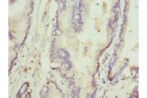 Immunohistochemistry of paraffin-embedded human prostate cancer using ABIN7168074 at dilution of 1:100