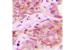 Immunohistochemical analysis of Mammaglobin B staining in human breast cancer formalin fixed paraffin embedded tissue section.