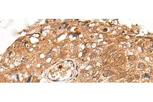 Immunohistochemistry of paraffin-embedded Human lung cancer tissue using KLHL36 Polyclonal Antibody at dilution of 1:55(x200)