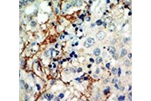 IHC analysis of FFPE human breast carcinoma tissue stained with the EphA3 antibody (EPH Receptor A3 Antikörper  (AA 115-144))