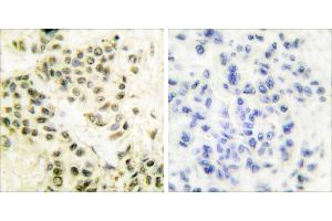 Peptide - +Immunohistochemical analysis of paraffin-embedded human breast carcinoma tissue using DNA-PK antibody. (PRKDC Antikörper)
