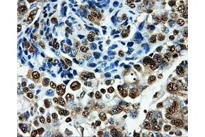 Immunohistochemical staining of paraffin-embedded Adenocarcinoma of breast tissue using anti-PKMYT1 mouse monoclonal antibody. (PKMYT1 Antikörper)